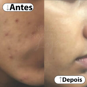 creme perola antes e depois 1