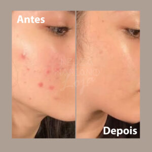 creme perola antes e depois 5