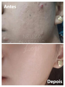 creme perola antes e depois 6