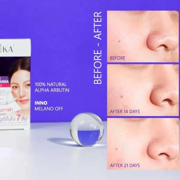 KA White Spot Cream: O Especialista Tailandês no Combate ao Melasma e Manchas Escuras 2 creme para melasma - vista 2
