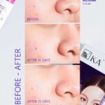 Creme para Melasma