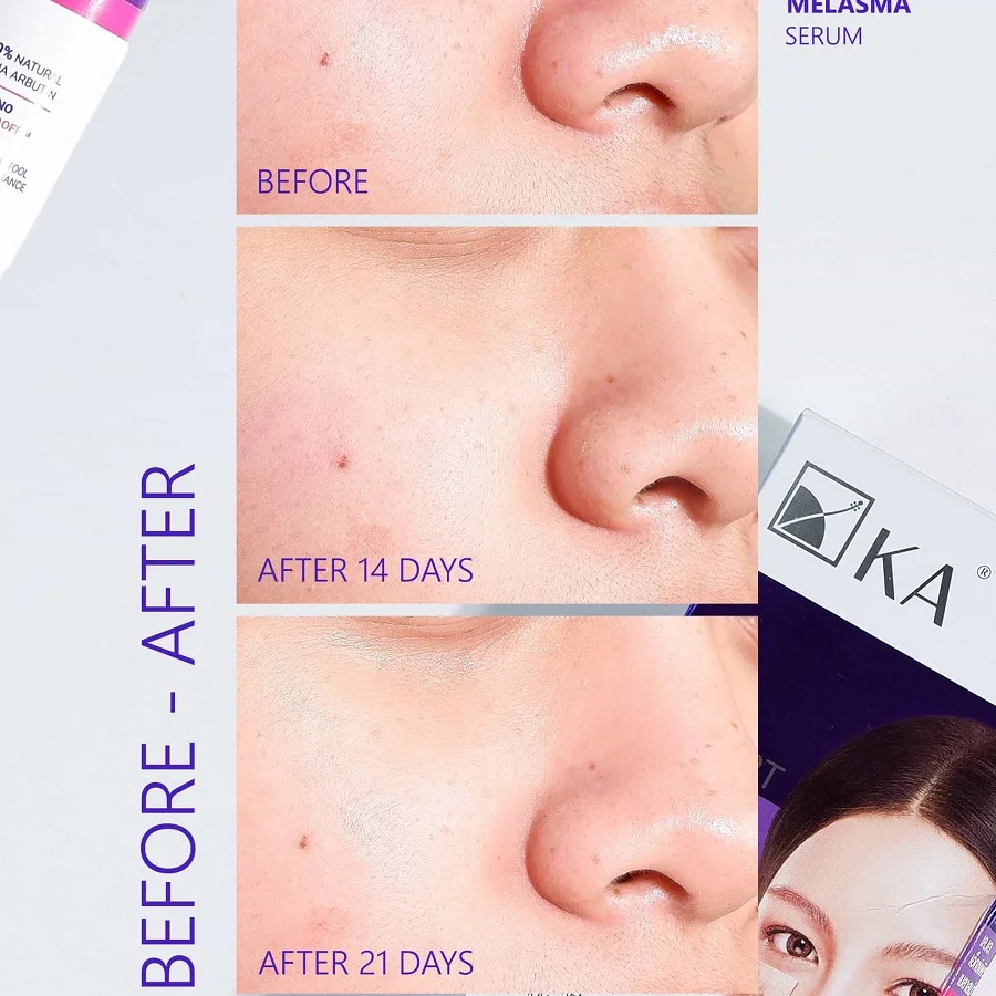 KA White Spot Cream: O Especialista Tailandês no Combate ao Melasma e Manchas Escuras 4 creme para melasma - vista 4