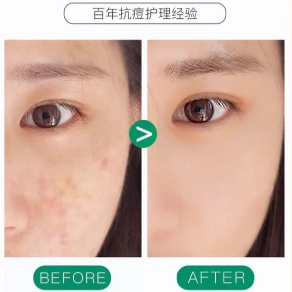 gel anti-acne - vista 2