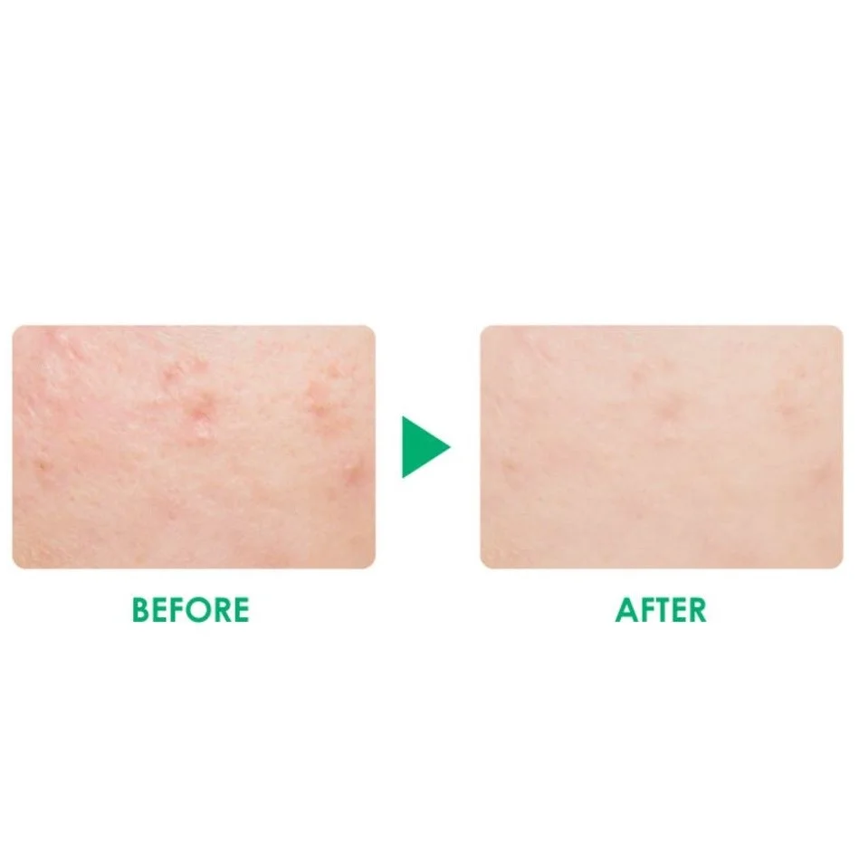 CC Cream Anti Acne - vista 4