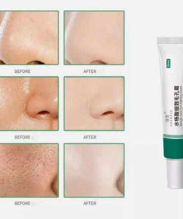 ácido salicílico - vista 2