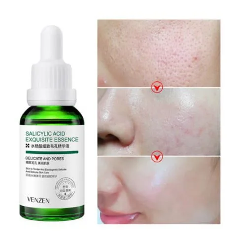 Venzen Salicylic Acid Essence: Adeus Poros Obstruídos, Pontos Negros e Oleosidade 2 Venzen Salicylic Acid Essence
