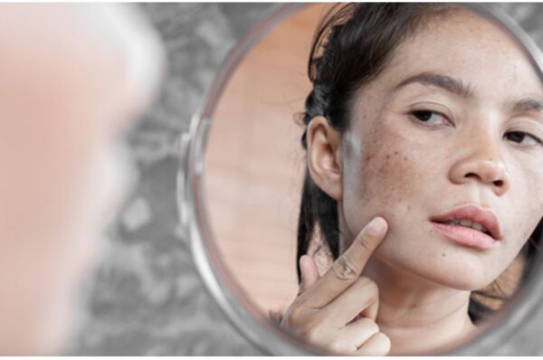 Melasma