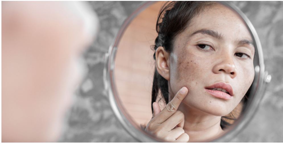 Melasma