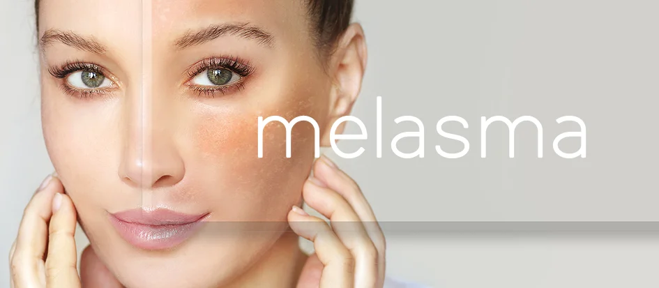 Melasma