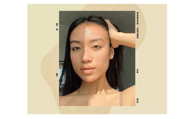 Cicatrizes de Acne