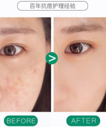 gel anti-acne - vista 2